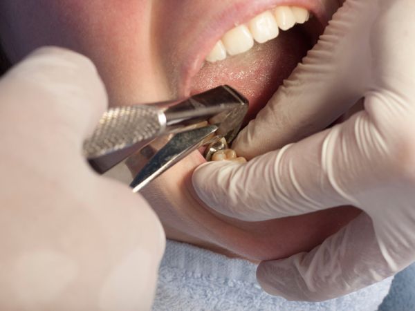 estrazione dente